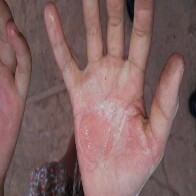 Mãe é presa acusada de queimar mãos da filha com colher