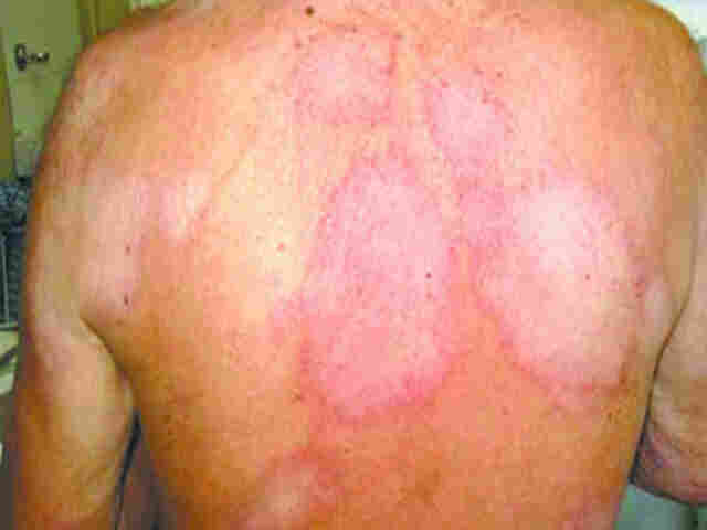 Brasil ocupa 2ª posição no ranking de novos casos de hanseníase; Diagnóstico precoce ajuda do tratamento