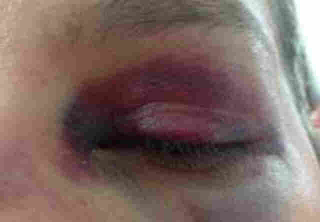 Mulher é agredida com soco no olho pelo próprio irmão durante bebedeira, na Capital