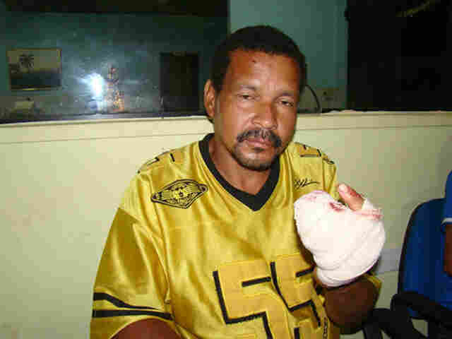 Embriagado tem três dedos decepados em briga de família e foge do hospital