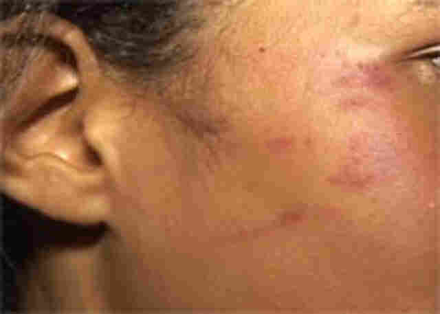 RondoniagoraTV: Adolescente agredida por pai de rival durante briga