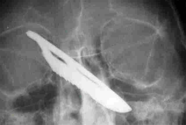 PM EVITA HOMICÍDIO, MAS É ATINGIDO COM FACADA NA CABEÇA