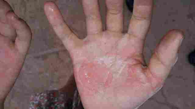 Mãe é presa acusada de queimar mãos da filha com colher