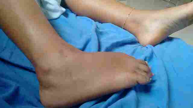 Em menos de uma semana, duas pessoas são picadas por cobra em Ouro Preto