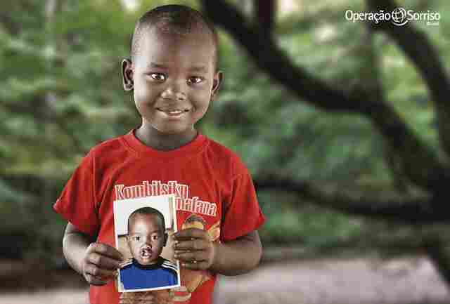 Operação Sorriso seleciona pacientes com fissura labiopalatina para mutirão de cirurgias em Porto Velho