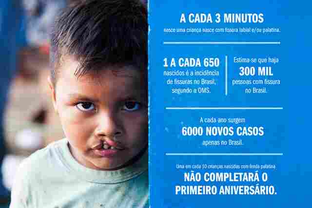 60 pacientes com fissura labial serão atendidos pela Operação Sorriso em Porto Velho