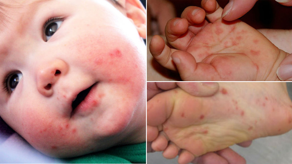 Para evitar vírus mão-pé-boca em crianças, é essencial cuidados com a higiene