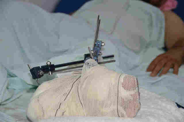 Em três meses, mais de 1.300 vítimas de acidentes de trânsito são atendidas no João Paulo II