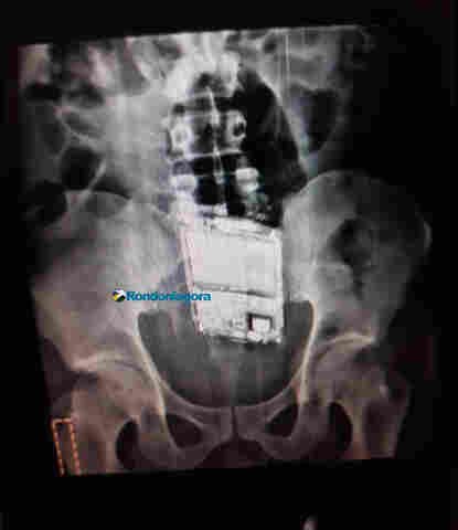 Apenado do Urso Branco é flagrado com celular escondido dentro do ânus