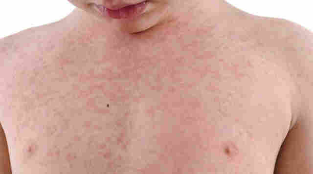 Após casos de sarampo confirmados, Rondônia fica em alerta e antecipa campanha de vacinação