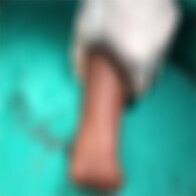 Médicos amputam mão de criança após estouro de bomba em brincadeira na Capital