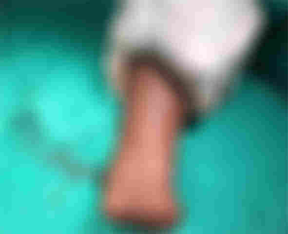 Médicos amputam mão de criança após estouro de bomba em brincadeira na Capital