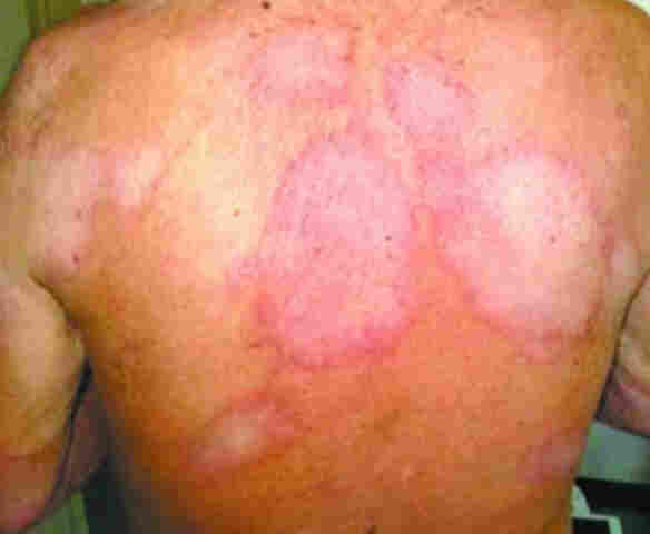 Diagnóstico e tratamento precoce da hanseníase dificulta proliferação de doença em Rondônia