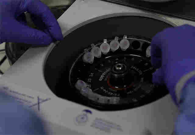 Casos suspeitos de Coronavírus aumentam para 84 em 11 municípios de Rondônia; 51 são em Porto Velho