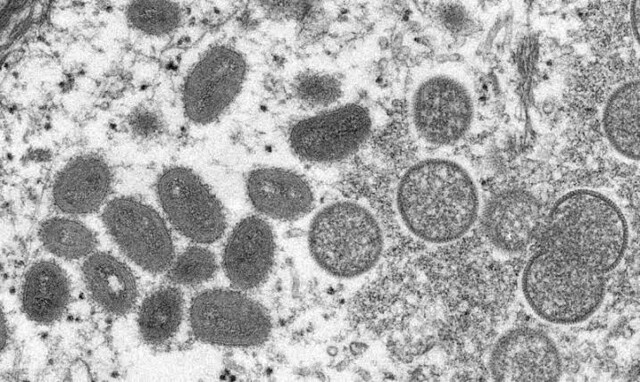 Casos rondonienses suspeitos de varíola do macaco são de Rio Crespo