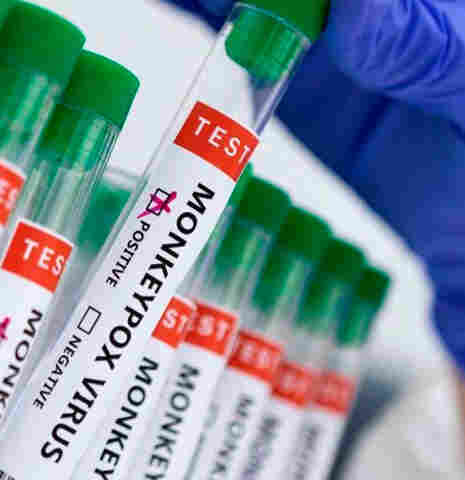 Dois casos de varíola dos macacos são confirmados em Rondônia