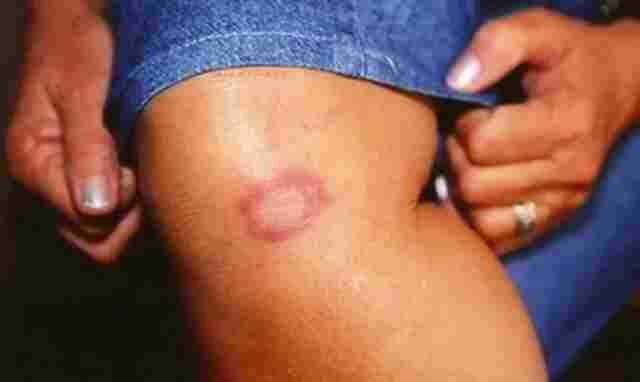 Hanseníase: conheça verdades e mitos sobre a doença
