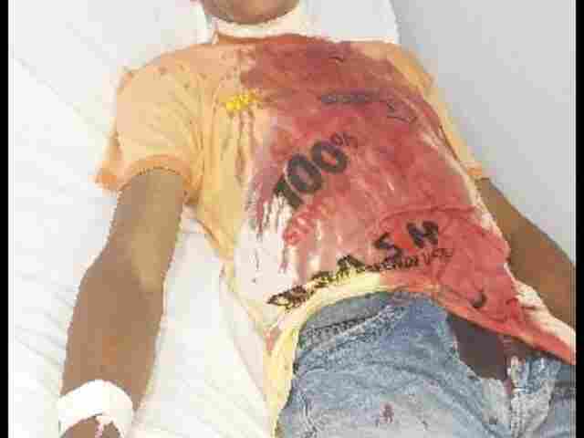 Mais uma vítima do cerol: homem tem pescoço cortado por linha enquanto andava de bicicleta